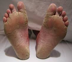 Fungal Skin Infections
