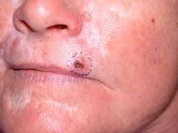 Basal Cell Carcinoma (BCC)