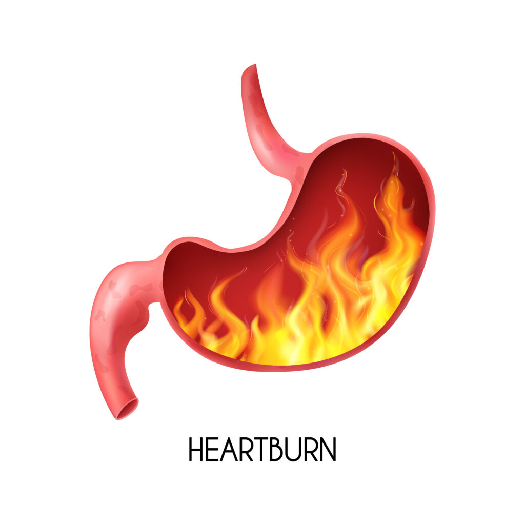 What is heartburn