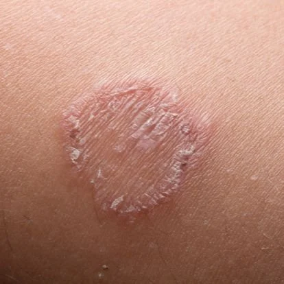 Fungal Skin Infections