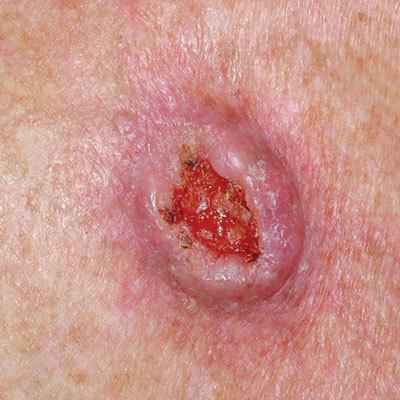 Squamous Cell Carcinoma (SCC)
