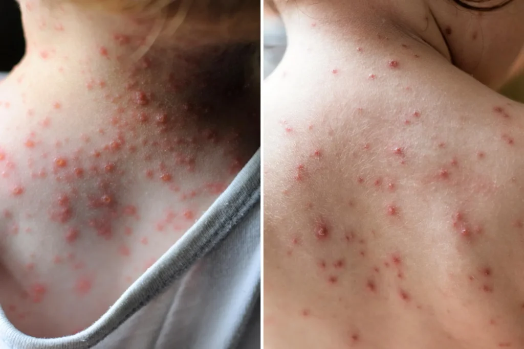 Viral Skin Infections
