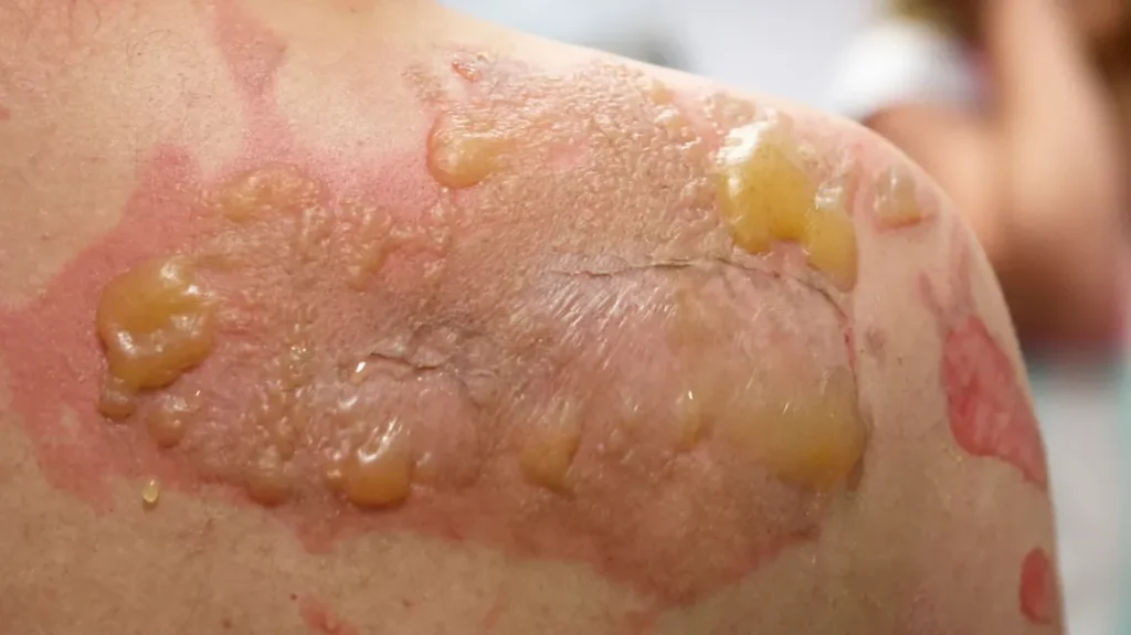 Bacterial Skin Infections