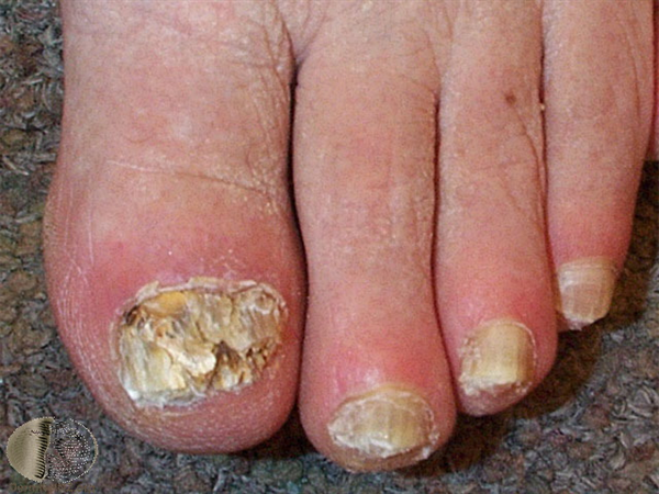 Fungal Skin Infections