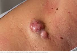 Dermatofibrosarcoma Protuberans (DFSP)