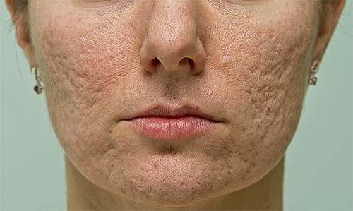 acne scars