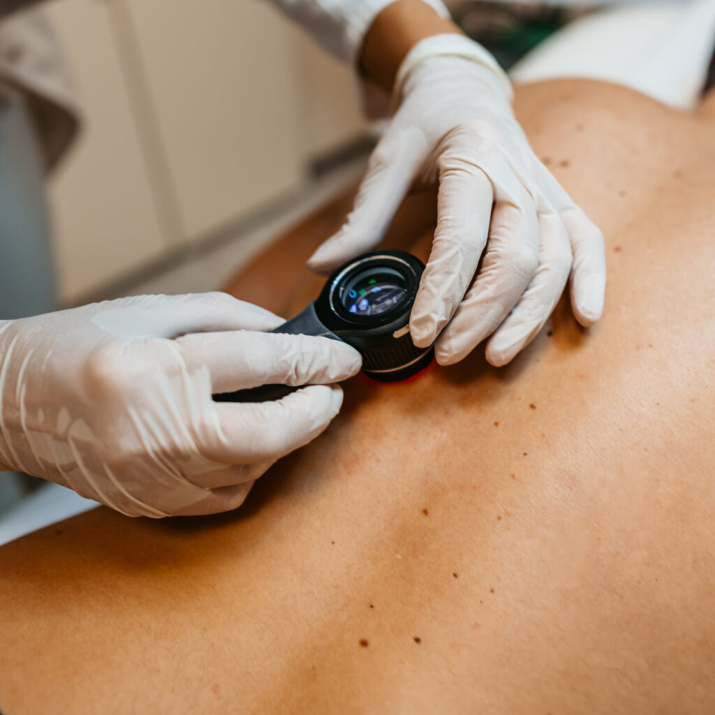Melanoma causes