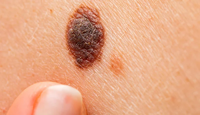 Melanoma Causes