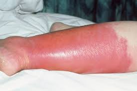 Bacterial Skin Infections