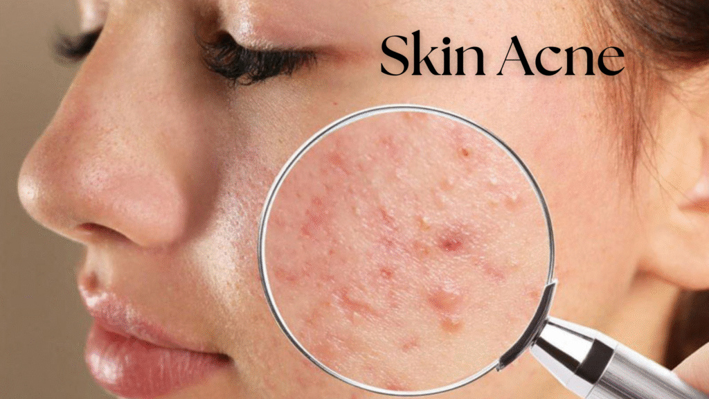 skin acne