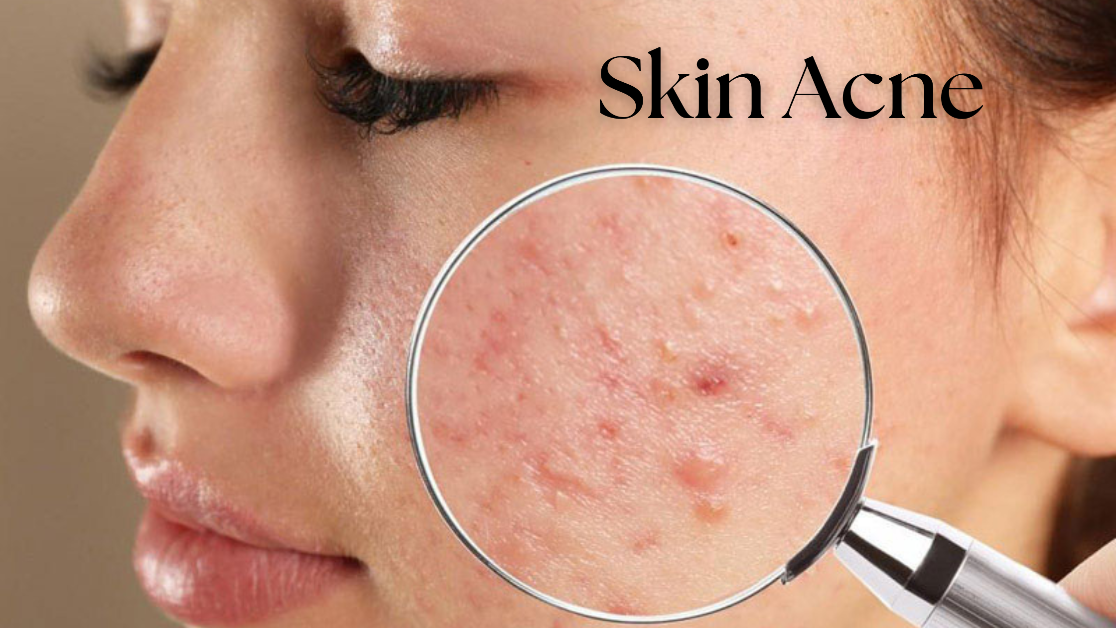 skin acne