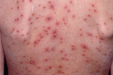 Viral Skin Infections