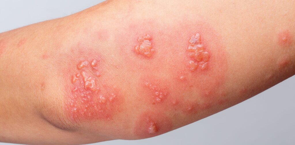 Bacterial Skin Infections