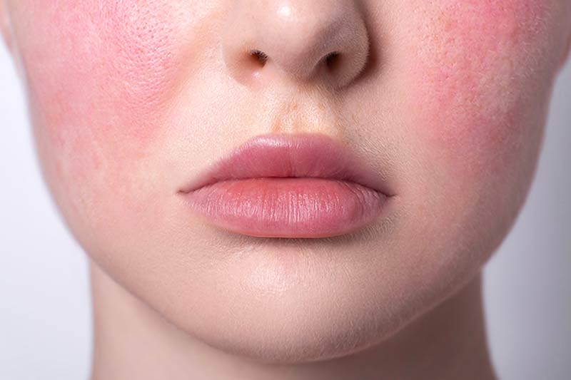 What is Rosacea