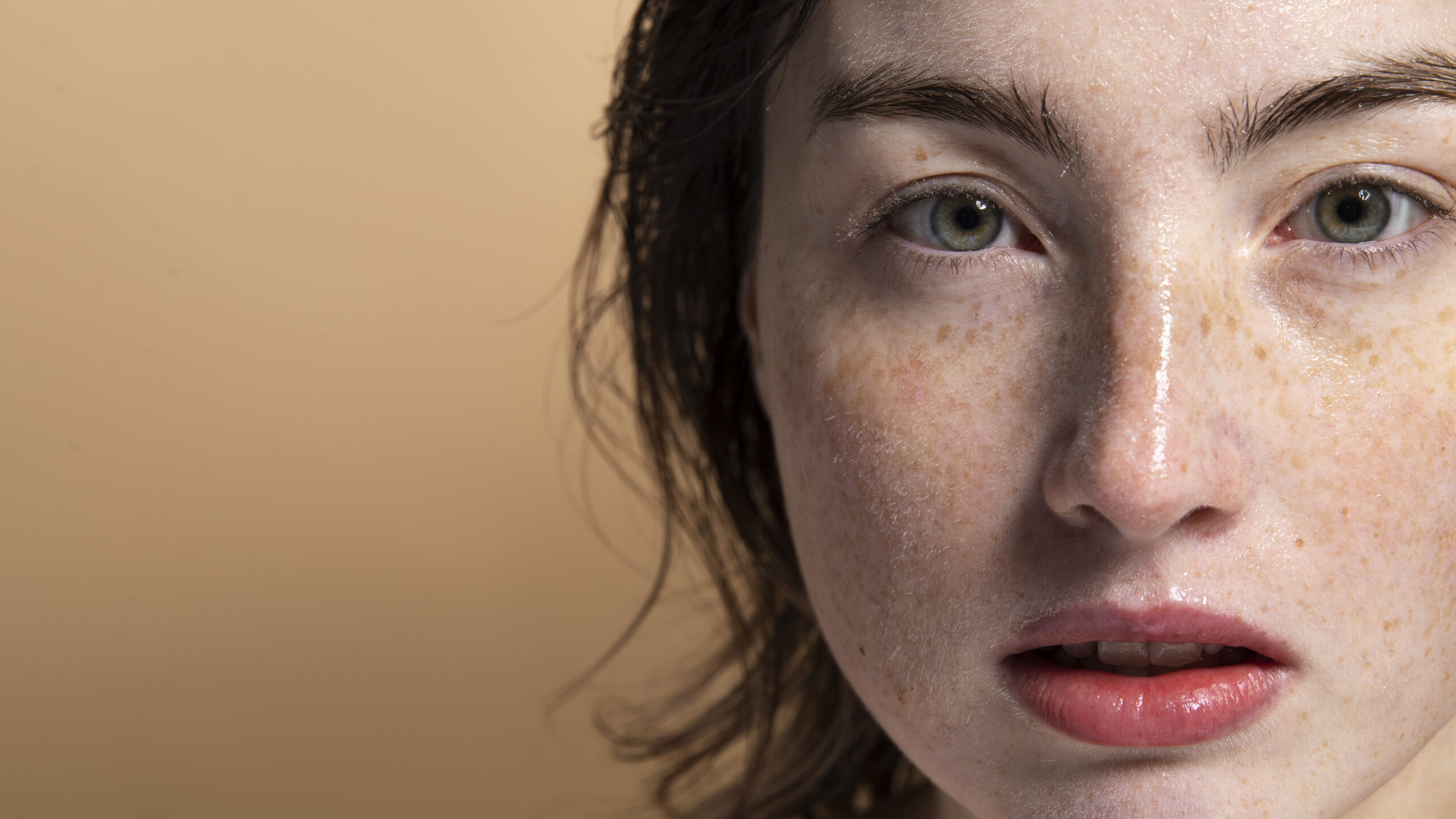 What is Melasma