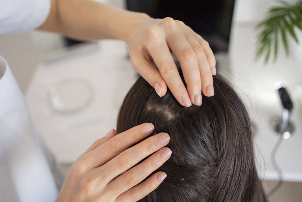 Dandruff vs Psoriasis