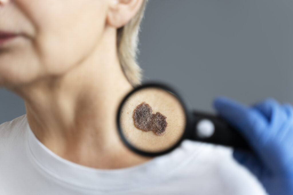 types of skin cancer