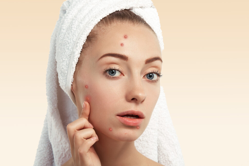 seasonal acne