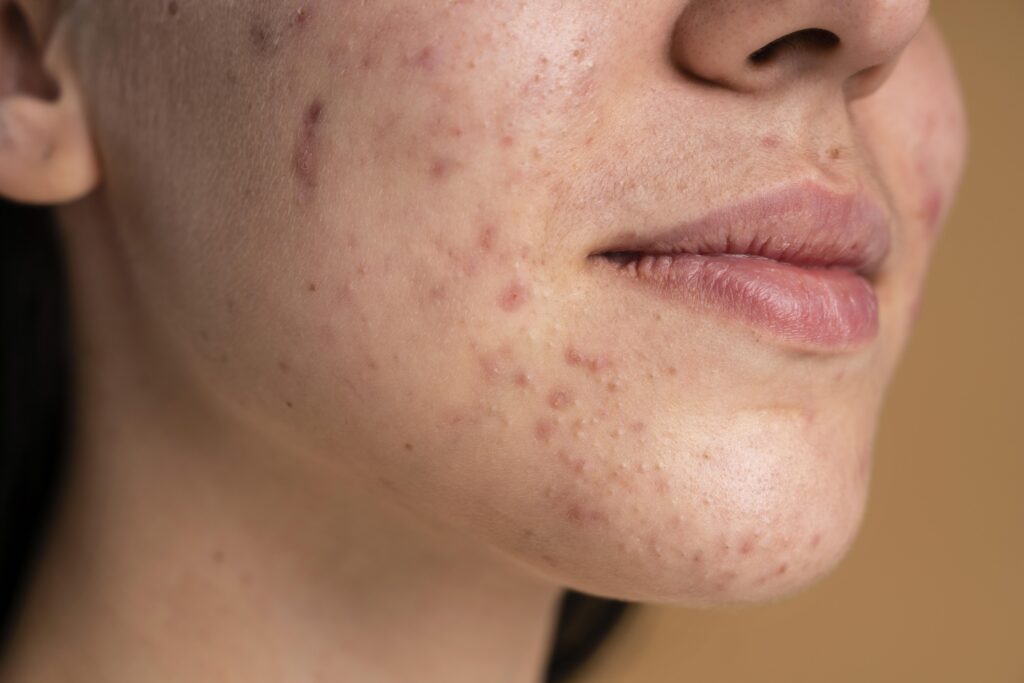 hormonal acne vs. bacterial acne