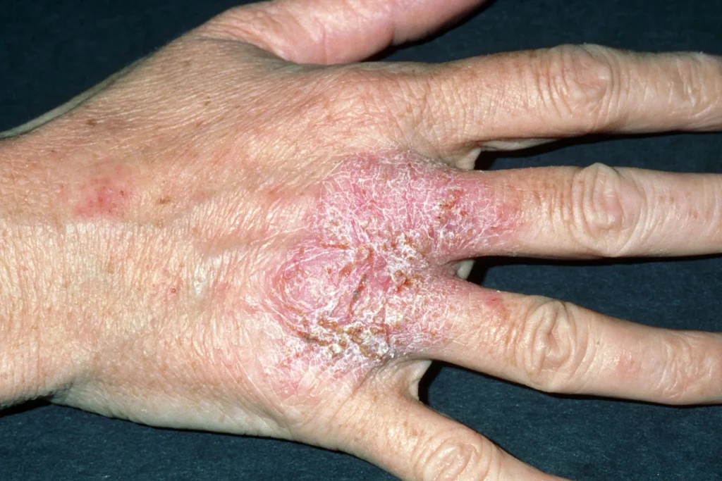 eczema