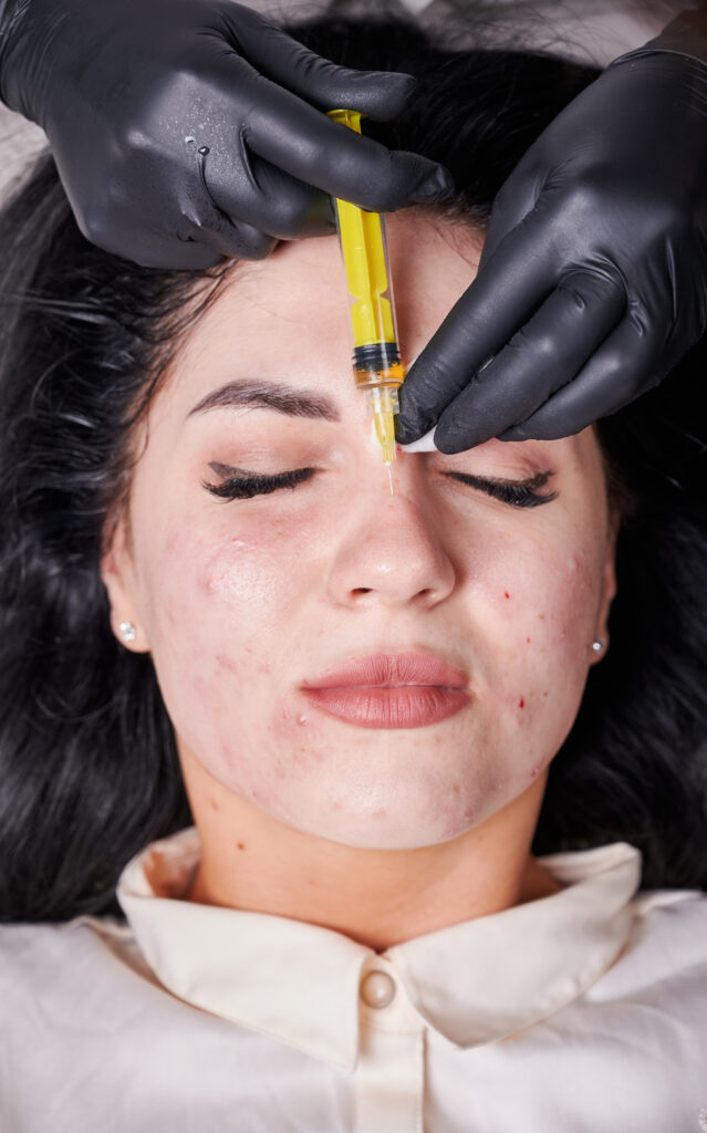 Microneedling for Acne Scars