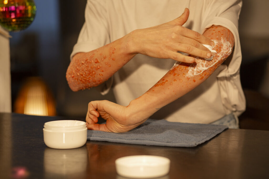 eczema remedies