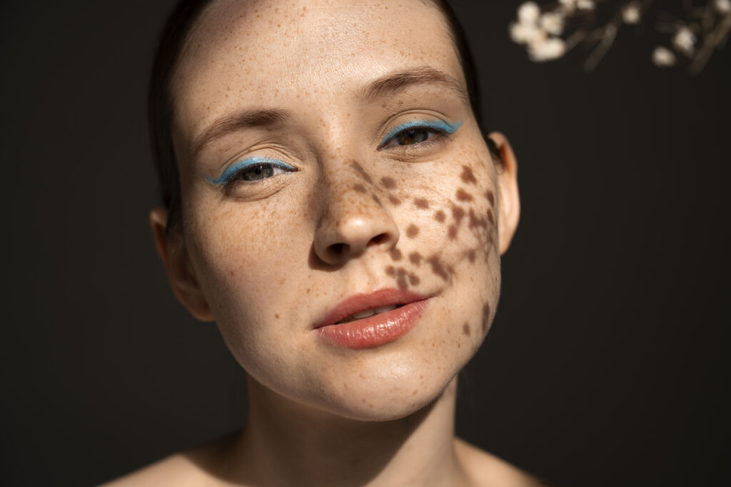 Hyperpigmentation