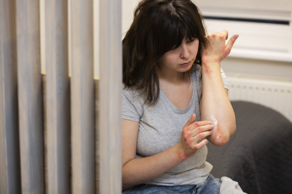 Psoriasis