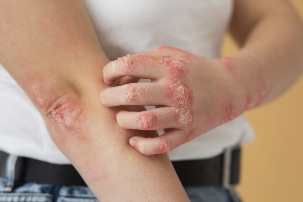 Psoriasis