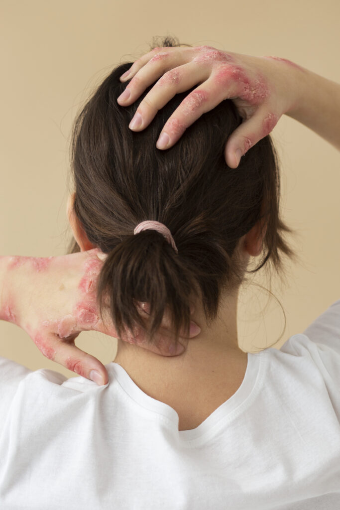 dandruff vs psoriasis