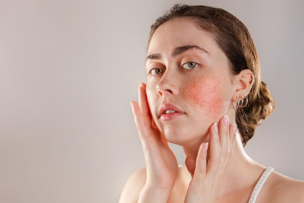 most common rosacea triggers