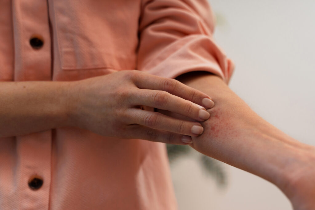 seborrheic dermatitis