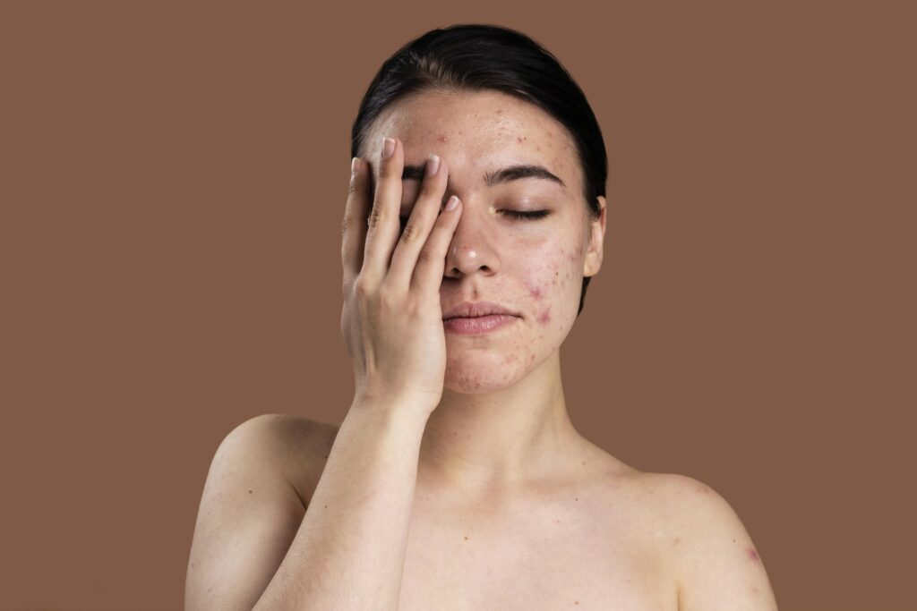 harmonal acne vs bacterial acne