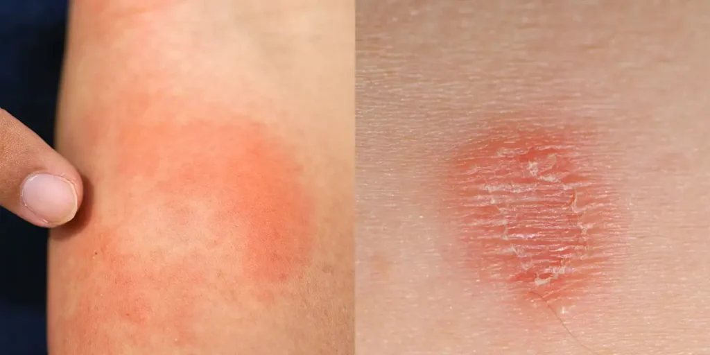 Ringworm vs Eczema