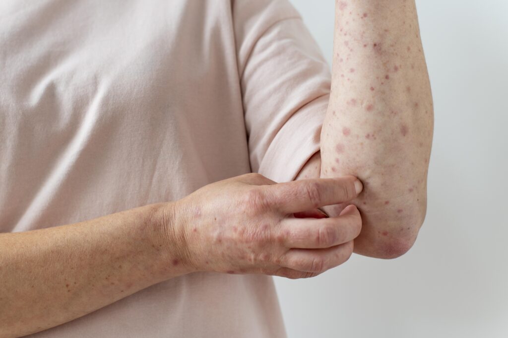 Fungal Skin Infections
