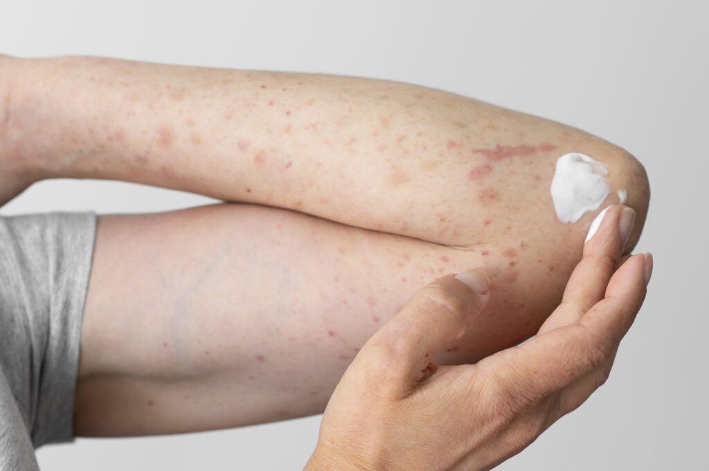 Atopic Dermatitis