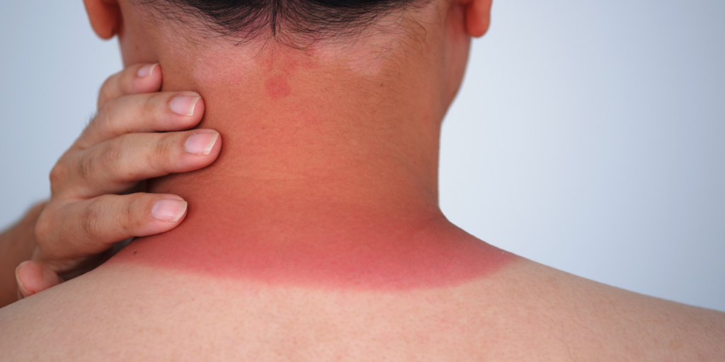 summer skin problems