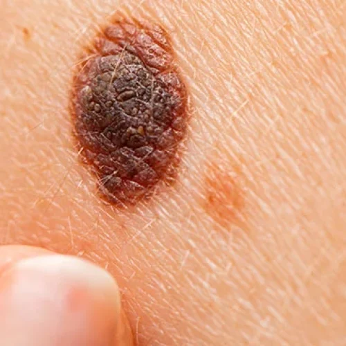 Melanoma Causes