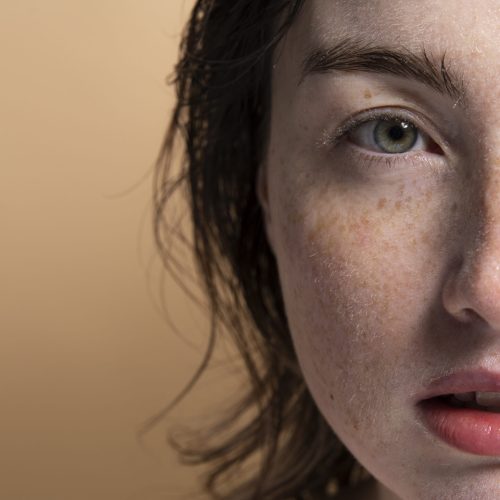 What is Melasma