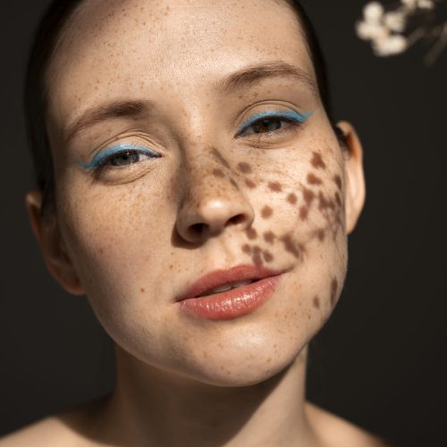 What is Hyperpigmentation – 5 Most Common Causes